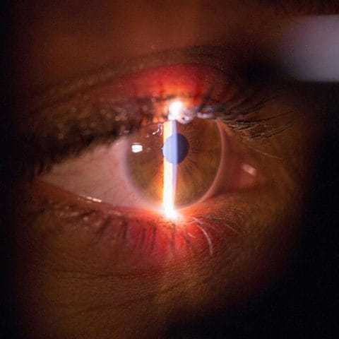 Prosedur Operasi LASIK dengan Teknologi Laser Terkini