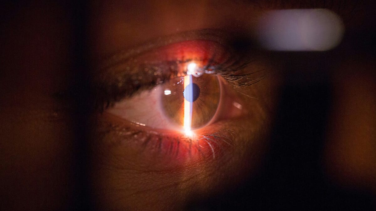 Prosedur Operasi LASIK dengan Teknologi Laser Terkini